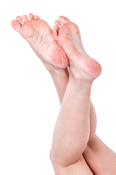 сухая обезвоженная кожа на пятках женских ног с мозолями

