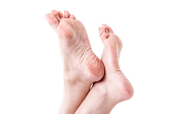 сухая обезвоженная кожа на пятках женских ног с мозолями
