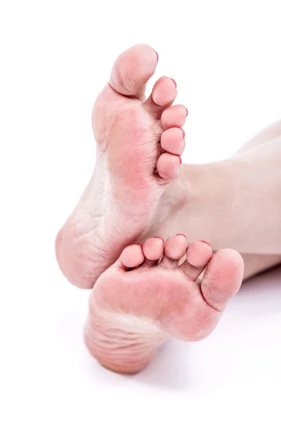 Piel seca deshidratada en los talones de los pies femeninos con callos —  Fotos de Stock