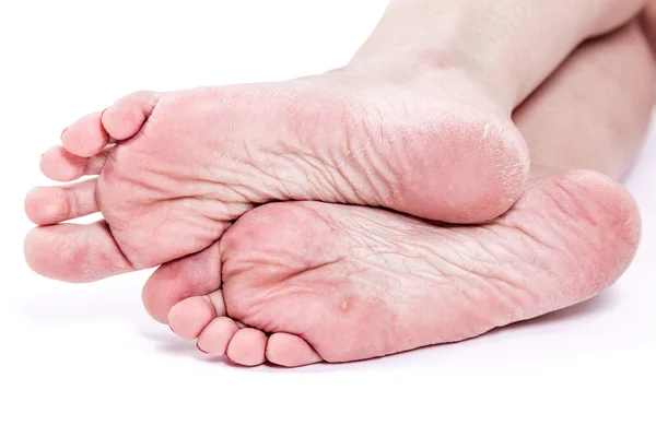 Dry dehydrated skin on the heels of female feet with calluses — Stock Photo, Image