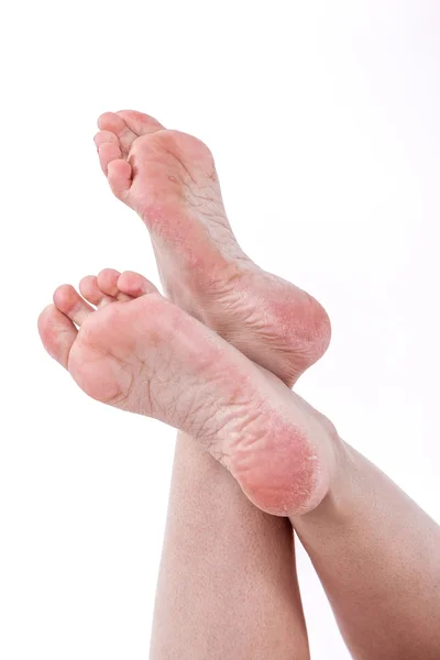 Dry dehydrated skin on the heels of female feet with calluses — Stock Photo, Image