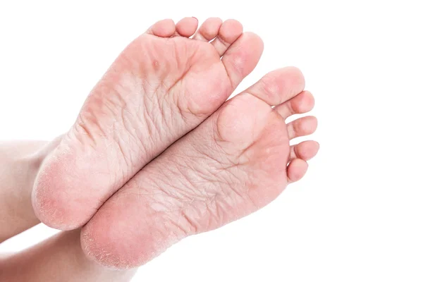 Female legs with overdried dehydrated dry skin on heels closeup — Stock Photo, Image