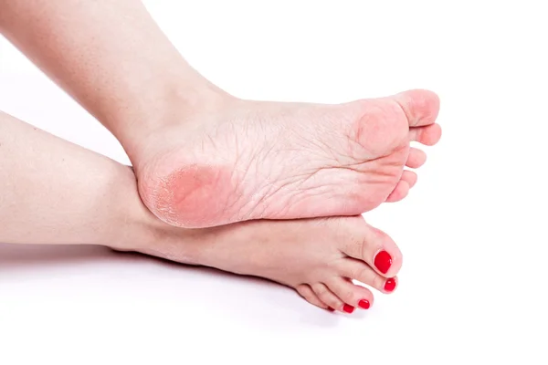 Dry dehydrated skin on the heels of female feet with calluses — Stock Photo, Image