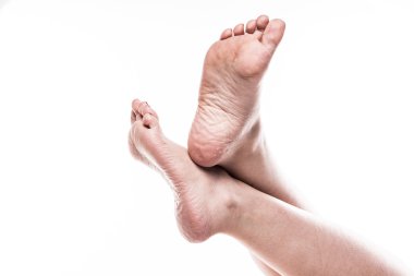 female foot with pedicure and poor over-dry skin on the heels of clipart