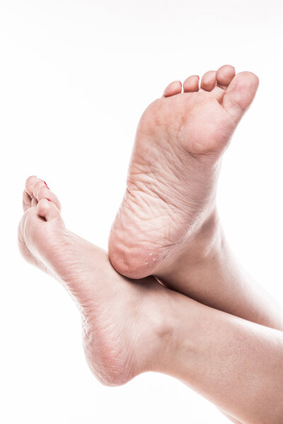 женская нога с педикюром и бедной пересушенной кожей на пятках
