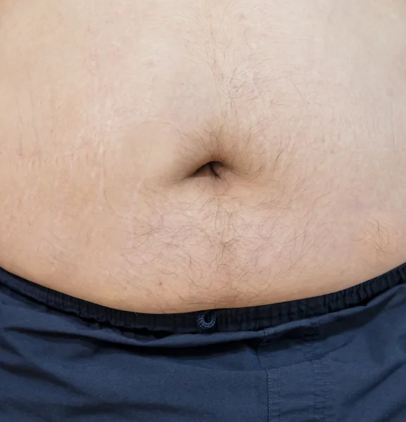 Obesity of male — Stock Photo, Image