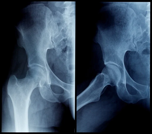 Skiagram 人間の股関節 — ストック写真