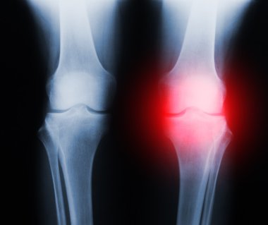 Xray knee joint trauma clipart