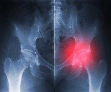 X-ray hip trauma clipart
