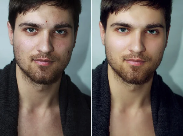 Before and after cosmetic operation. Young pretty man portrait — Stock Photo, Image