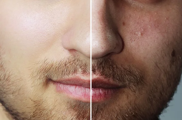 Antes y después de la operación cosmética. Joven retrato de hombre bonito — Foto de Stock