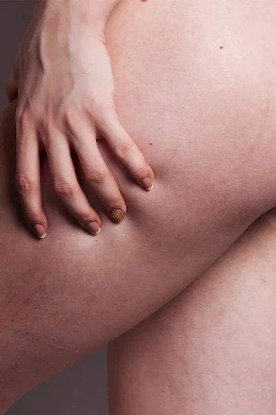 Mulher mostrando Celulite isolada em cinza — Fotografia de Stock
