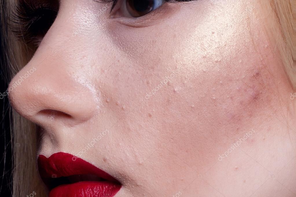 Young girl's typical problem acne and pimples puberty Stock Photo by