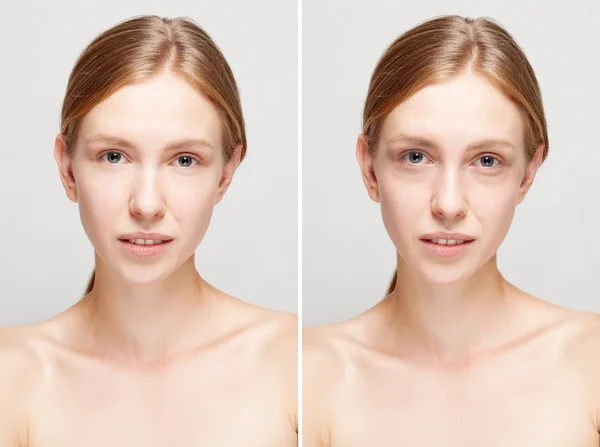 Antes e depois da operação cosmética . — Fotografia de Stock