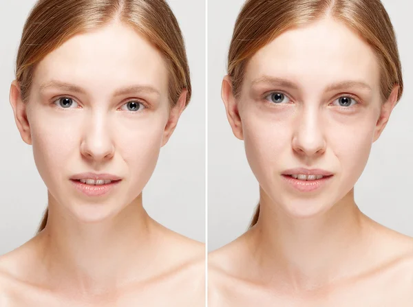 Before and after cosmetic operation. — Stock Photo, Image