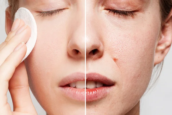 Happy woman cleaning her face with cotton pads — Stock Photo, Image