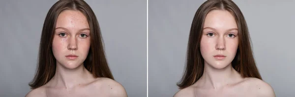 Saúde Pessoas Juventude Conceito Beleza Antes Depois Operação Cosmética Retrato — Fotografia de Stock