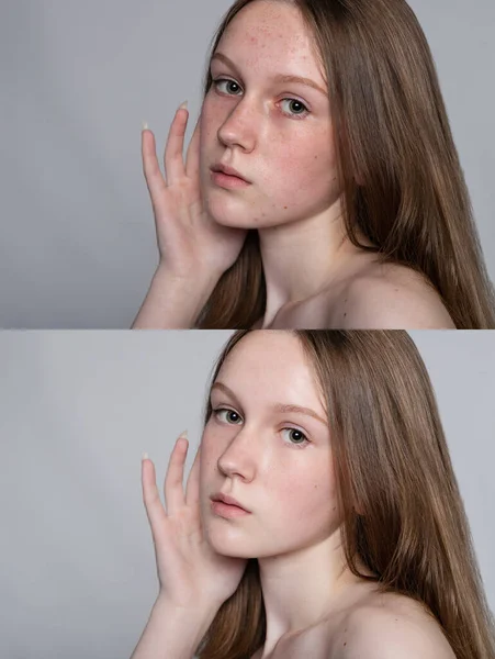 Gesundheit Menschen Jugend Und Schönheitskonzept Vor Und Nach Kosmetischen Operationen — Stockfoto