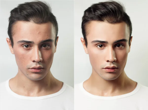 Avant et après l'opération cosmétique. Jeune joli portrait d'homme — Photo