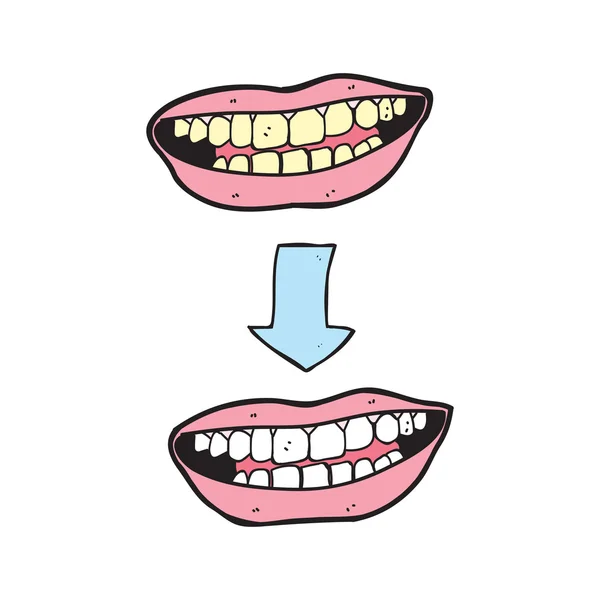 Dessin animé avant et après le blanchiment des dents ou le traitement de blanchiment . — Image vectorielle