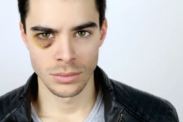 Handsome young man with a shiner — Stock Photo, Image