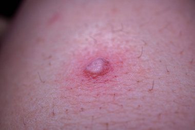 İnsan derisindeki deri lezyonunun yakın çekimi, kızarıklığı ve kabarıklığı gösteriyor, etrafında ince saçlar var.
