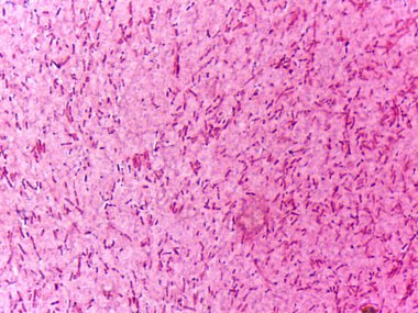 Pembe lekeli doku örneğinin mikroskobik görüntüsü çok sayıda uzun yapıyı gösteriyor.