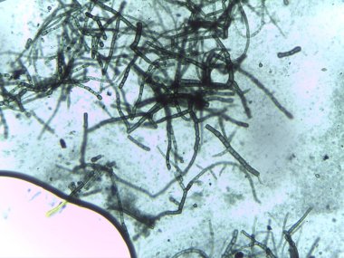 Yoğun bir ağda iç içe geçmiş septik ve dematiasöz mantar hifabesini gösteren mikrograf.