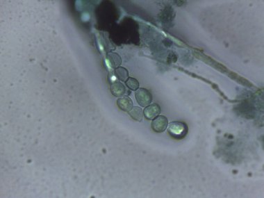 Yoğun bir ağda iç içe geçmiş septik ve dematiasöz mantar hifabesini gösteren mikrograf.