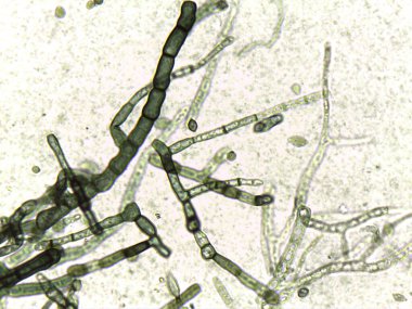 Kalın duvarlı, septik hyphae ve dematiaceous mantar parçalarını gösteren mikrograf..