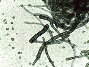 Kalın duvarlı, septik hyphae ve dematiaceous mantar parçalarını gösteren mikrograf..