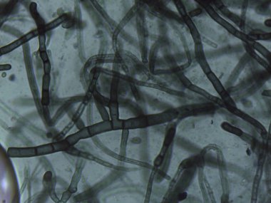 Yoğun bir ağda iç içe geçmiş septik ve dematiasöz mantar hifabesini gösteren mikrograf.