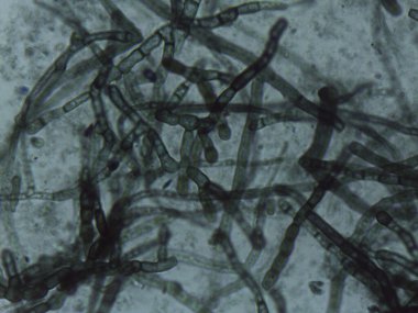 Yoğun bir ağda iç içe geçmiş septik ve dematiasöz mantar hifabesini gösteren mikrograf.