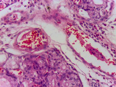 Pembe ve mor lekeli hücreleri gösteren mikroskobik doku görüntüsü çeşitli hücre yapılarını ve muhtemelen iltihaplanmayı gösteriyor.