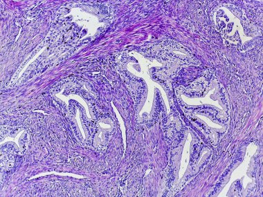 Mor lekeli dokunun mikroskobik görüntüsü, hücresel yapıları ve bağ dokusunu gösteriyor, histolojik analizin göstergesi.