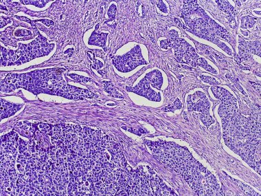 Mor lekeli dokunun mikroskobik görüntüsü, hücresel yapıları ve yapıları gösteriyor