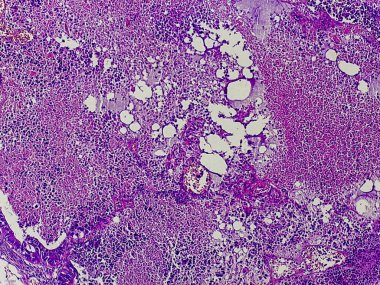 Karmaşık bir yapıya sahip mikroskobik bir doku görüntüsü, çeşitli hücre tipleri ve kalıpları, ağırlıklı olarak mor ve beyaz tonlarında, biyolojik bir örneğin göstergesi.