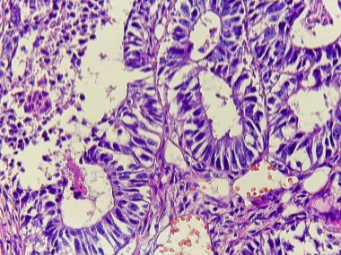 Mor hücreli ve yapılı dokunun mikroskobik görüntüsü, hücresel detayları ve kalıpları gösteriyor