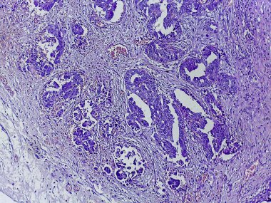 Mor lekeli dokunun mikroskobik görüntüsü, hücresel yapıları ve kalıpları gösteriyor, muhtemelen patoloji veya histolojiyle ilgili.