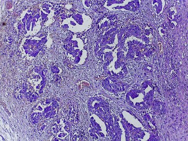 Mor lekeli dokunun mikroskobik görüntüsü, hücresel yapıları ve kalıpları gösteriyor, muhtemelen patoloji veya histolojiyle ilgili.