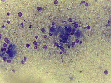 Yüksek Büyütme Sitolojisi Atipik yuvarlak hücrelerin monoton popülasyonunu gösteren Smear Lenfoma / Le