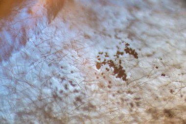 Septate Dematiaceous Mantar Hyphae ve Olası Chlamydozpores mikroskobik Görünümü