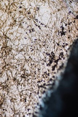 Septate Dematiaceous Mantar Hyphae ve Olası Chlamydozpores mikroskobik Görünümü