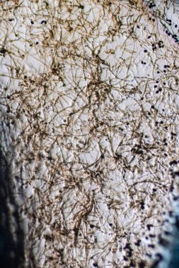 Septate Dematiaceous Mantar Hyphae ve Olası Chlamydozpores mikroskobik Görünümü
