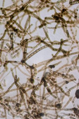 Septate Dematiaceous Mantar Hyphae ve Olası Chlamydozpores mikroskobik Görünümü