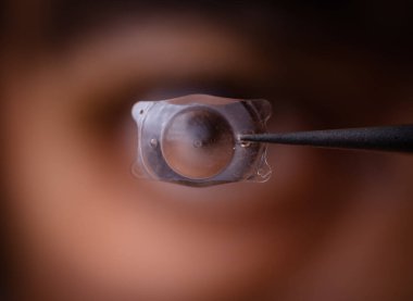 İnsan gözünün önünde kırılma hatalarını tedavi etmek için implante edilebilir Collamer lenslerinin fotoğrafı
