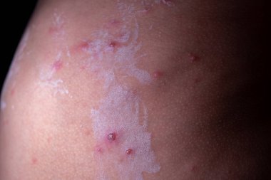 Sivilceli ve yara izli bir cilt, doku ve kusurları gösteriyor.