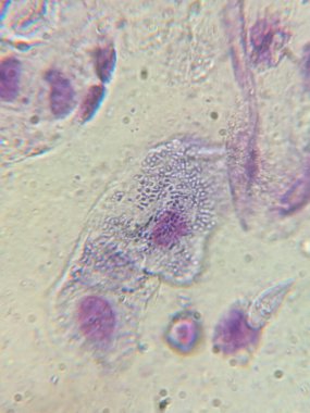 Balgam içinde Nükleus ve Bitişik Bakteri içeren Giemsa-Lekeli Squamous Epitel Hücreler