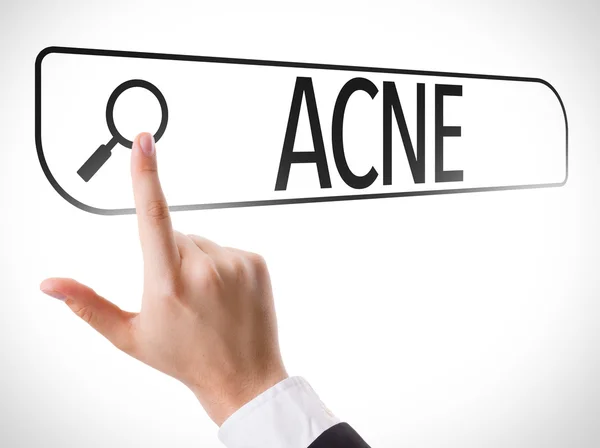 Acne written in search bar — Stock Photo, Image