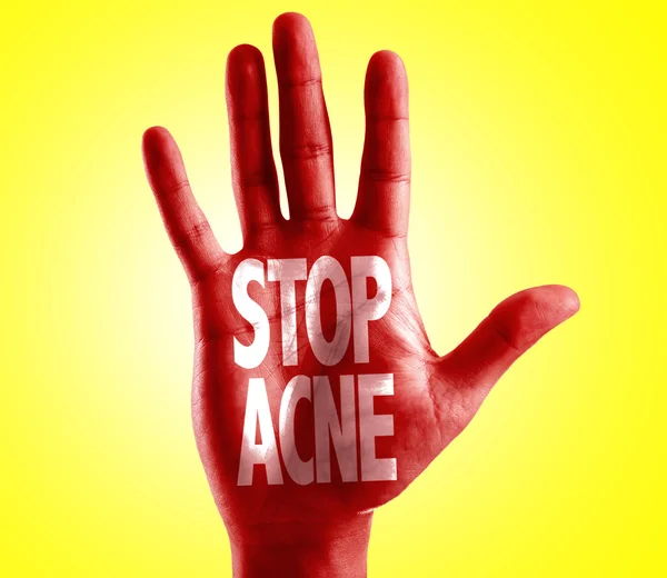 Stop Acne written on hand — Stock Photo, Image